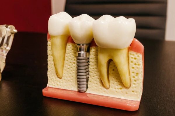 Missing teeth? Our Dental Implants for you